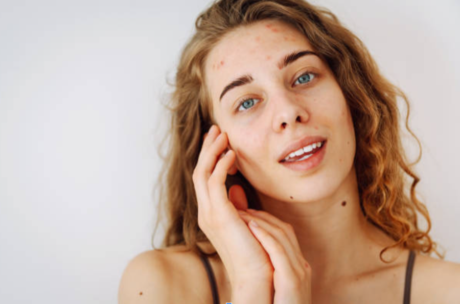 Can Stress Really Cause Pimples?